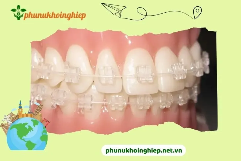 Khám phá top 5 Nha Khoa Niềng Răng Mắc Cài Sứ Dây Trong Hải Dương